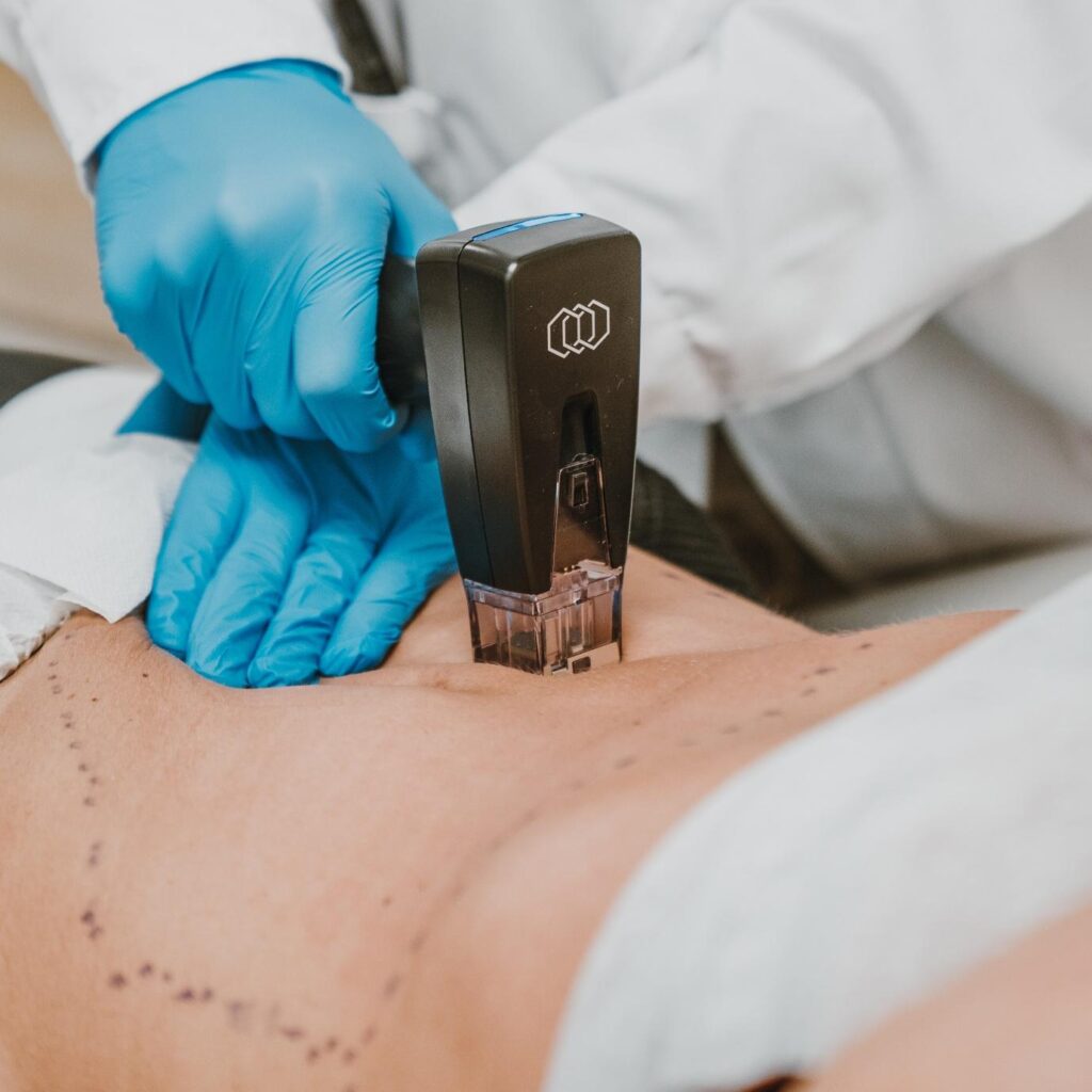 tratamento flacidez abdominal com morpheus8 na Living Clinic