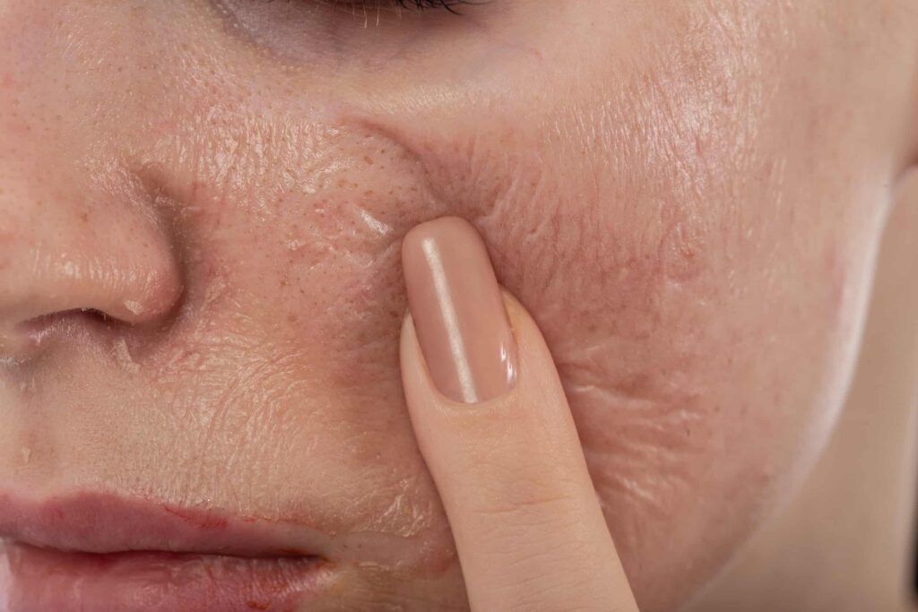 peeling químico