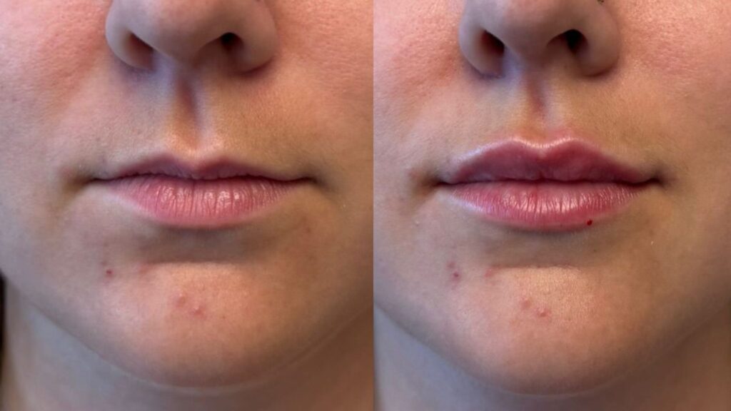 Lip filling with Hyaluronic Acid before and after photos