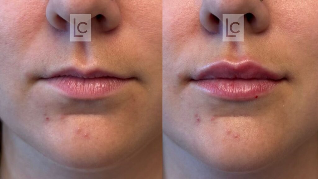 preenchimento labial antes e depois