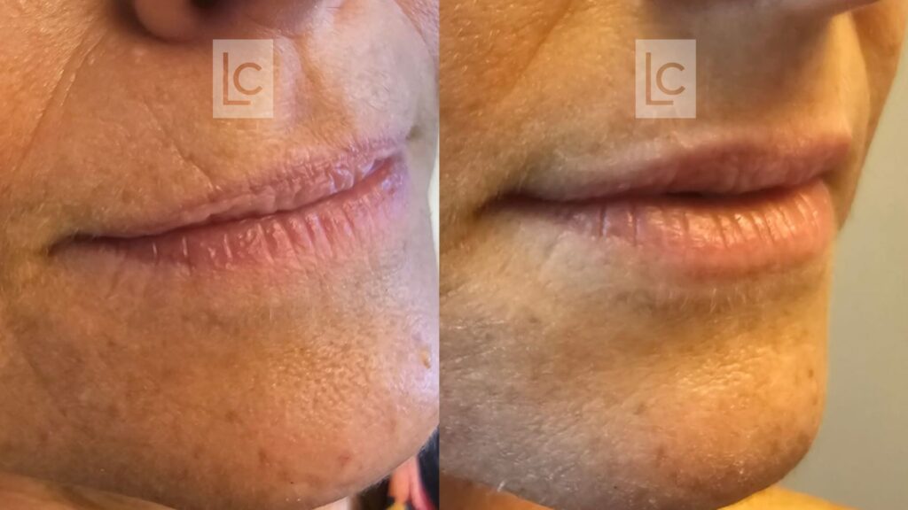 preenchimento labial com ácido hialurónico em paciente com idade mais avançada (fotos antes e depois)