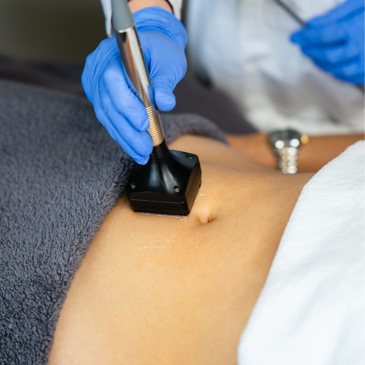 radiofrequência na barriga (na Living Clinic)