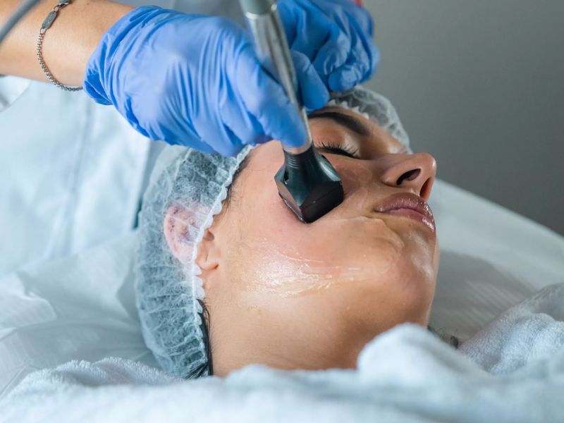 facial radiofrequency