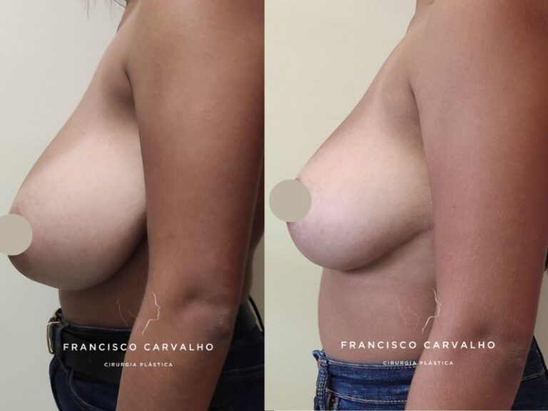 redução mama antes e depois