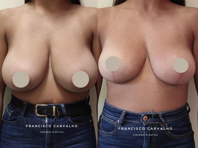 redução mamária antes e depois