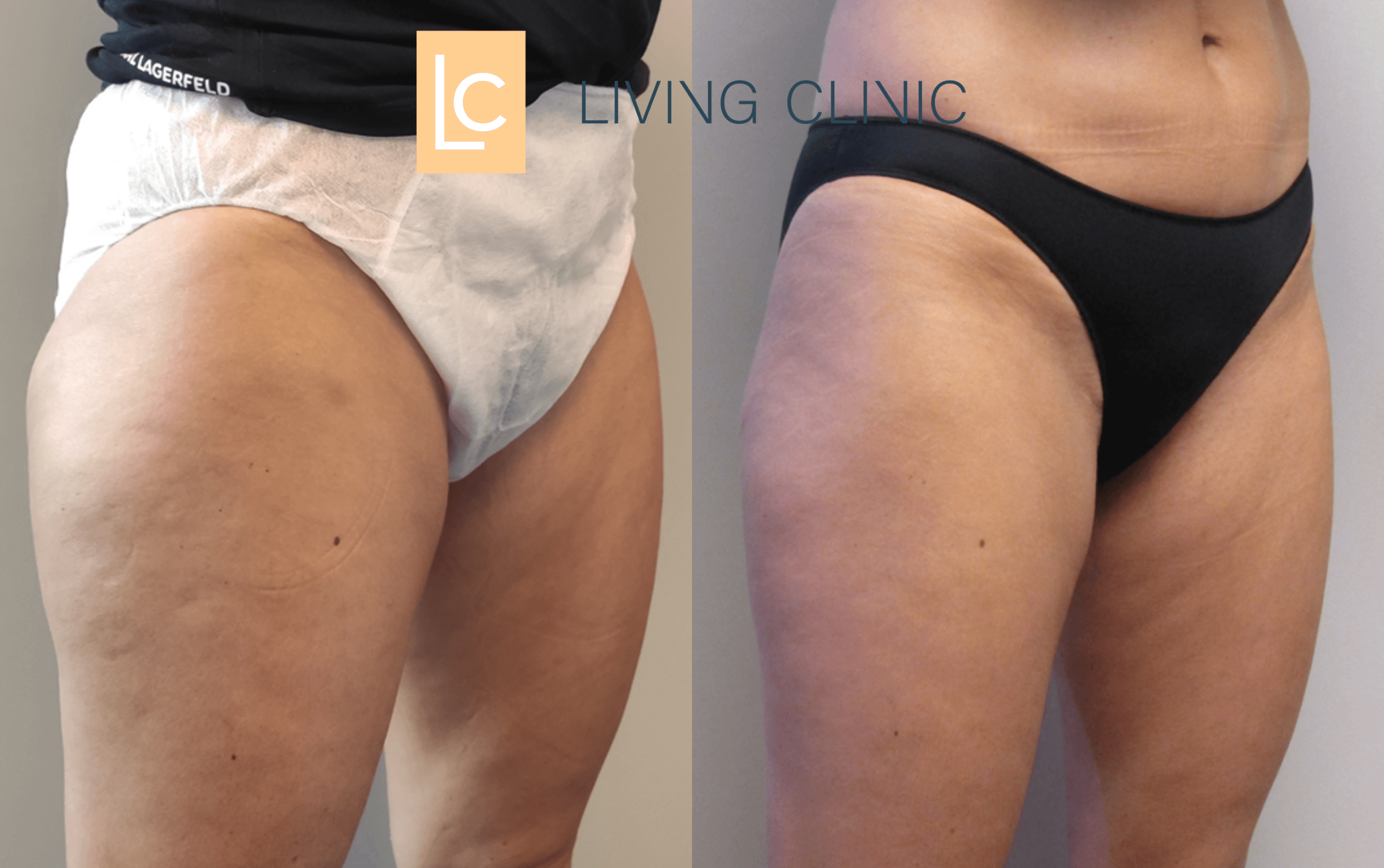 Thighs Coolsculpting Cryolipolysis Results