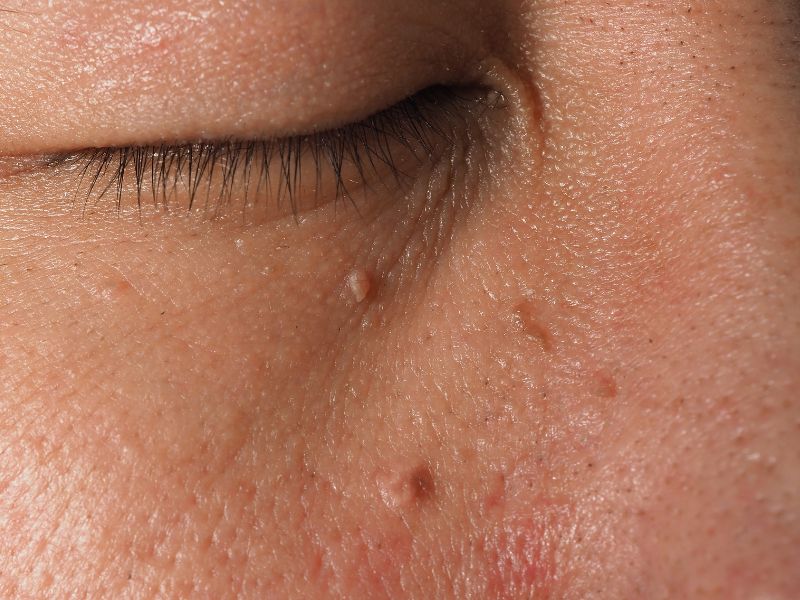 removing moles with laser