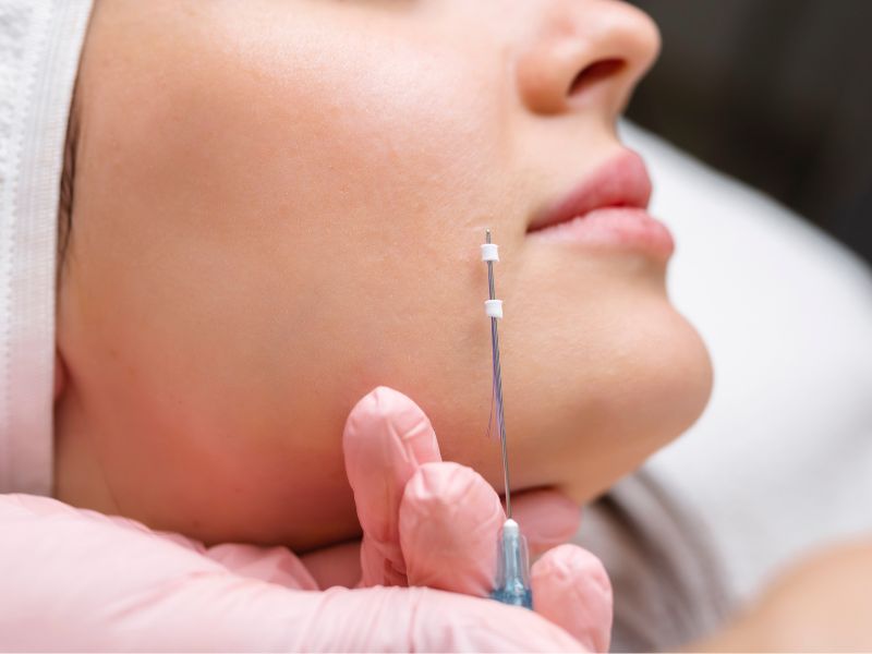 tratamento fios de PDO